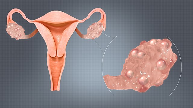 PCOD PCOS Polycystic Ovaries
